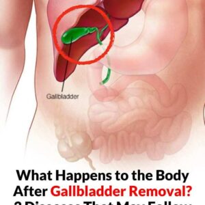 Understanding Gallbladder Removal: Symptoms, Recovery, and Long-Term Health Considerations